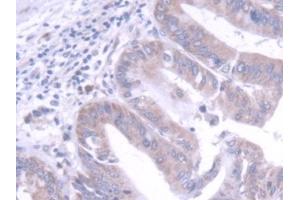 Detection of FGF20 in Human Liver cancer Tissue using Polyclonal Antibody to Fibroblast Growth Factor 20 (FGF20) (FGF20 抗体  (AA 1-211))