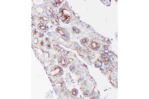 Anti-PCSK9 antibody, IHC(P): Human Intestinal Cancer Tissue (PCSK9 抗体  (C-Term))