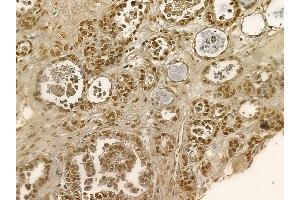 Nucleophosmin Mouse Monoclonal Antibody at 1/100 staining human ovarian cancer by IHC-P. (NPM1 抗体  (N-Term))