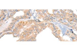 Immunohistochemistry of paraffin-embedded Human thyroid cancer tissue using RGS19 Polyclonal Antibody at dilution of 1:40(x200) (RGS19 抗体)