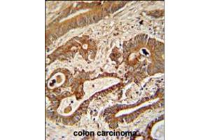 ETHE1 Antibody immunohistochemistry analysis in formalin fixed and paraffin embedded human colon carcinoma followed by peroxidase conjugation of the secondary antibody and DAB staining. (ETHE1 抗体  (AA 103-130))