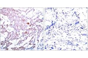 Immunohistochemistry analysis of paraffin-embedded human breast carcinoma, using NF-kappaB p65 (Phospho-Ser536) Antibody. (NF-kB p65 抗体  (pSer536))