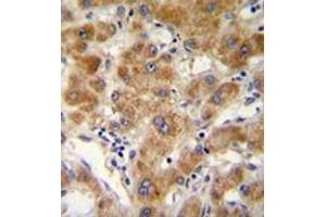Immunohistochemistry analysis in formalin fixed and paraffin embedded human hepatocarcinoma reacted with ODF3B Antibody (N-term) followed by peroxidase conjugation of the secondary antibody and DAB staining. (ODF3B 抗体  (N-Term))