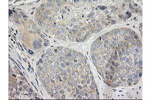 Immunohistochemical staining of paraffin-embedded Adenocarcinoma of Human breast tissue using anti-ITFG2 mouse monoclonal antibody. (ITFG2 抗体)