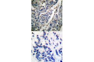 Immunohistochemical staining (Formalin-fixed paraffin-embedded sections) of human breast cancer tissue with SYT1 (phospho T202) polyclonal antibody  without blocking peptide (A) or preincubated with blocking peptide (B) under 1:50-1:100 dilution. (SYT1 抗体  (pThr202))