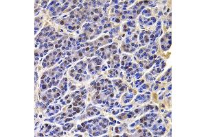 Immunohistochemistry of paraffin-embedded human liver cancer using HIRIP3 antibody at dilution of 1:100 (x400 lens). (HIRIP3 抗体)