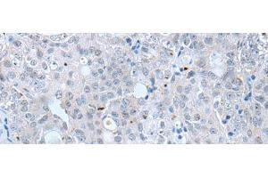 Immunohistochemistry of paraffin-embedded Human ovarian cancer tissue using CLDN12 Polyclonal Antibody at dilution of 1:45(x200) (Claudin 12 抗体)