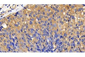 Detection of BCL2L11 in Human Breast cancer Tissue using Polyclonal Antibody to Bcl2 Like Protein 11 (BCL2L11) (BIM 抗体  (AA 2-120))