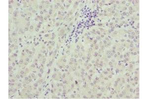 Immunohistochemistry of paraffin-embedded human liver cancer using ABIN7172689 at dilution of 1:100 (TAF5 抗体  (AA 656-800))