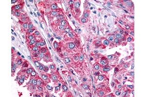 Anti-BAI2 antibody IHC of human Lung, Non-Small Cell Carcinoma. (BAI2 抗体  (C-Term))