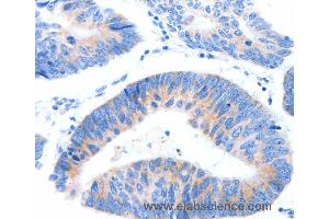 Immunohistochemistry of Human lung cancer using MUC3A Polyclonal Antibody at dilution of 1:60 (MUC3A 抗体)