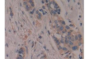 Detection of CYP27B1 in Human Breast cancer Tissue using Polyclonal Antibody to Cytochrome P450 27B1 (CYP27B1) (CYP27B1 抗体  (AA 256-508))