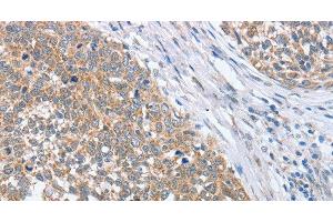 Immunohistochemistry of paraffin-embedded Human cervical cancer tissue using PAPSS1 Polyclonal Antibody at dilution 1:40 (PAPSS1 抗体)