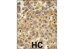 Formalin-fixed and paraffin-embedded human hepatocellular carcinoma reacted with DDX3X polyclonal antibody  , which was peroxidase-conjugated to the secondary antibody, followed by DAB staining.