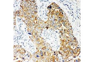 IHC-P: NOX5 antibody testing of human breast cancer tissue
