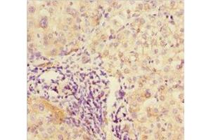 Immunohistochemistry of paraffin-embedded human liver cancer using ABIN7176590 at dilution of 1:100 (DPF1 抗体  (AA 261-380))