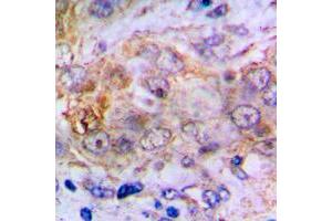 Immunohistochemical analysis of Carbonic Anhydrase 2 staining in human lung cancer formalin fixed paraffin embedded tissue section.