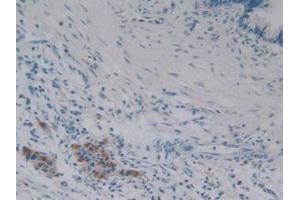 Detection of iPLA2 in Human Pancreas Tissue using Polyclonal Antibody to Phospholipase A2, Calcium Independent (iPLA2) (PNPLA2 抗体  (AA 484-701))