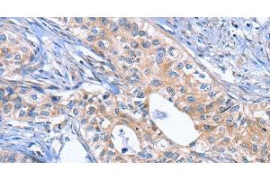 Immunohistochemistry of paraffin-embedded Human cervical cancer using INHBC Polyclonal Antibody at dilution of 1:50 (INHBC 抗体)