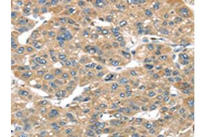 The image on the left is immunohistochemistry of paraffin-embedded Human liver cancer tissue using ABIN7192958(TUSC1 Antibody) at dilution 1/45, on the right is treated with synthetic peptide. (TUSC1 抗体)