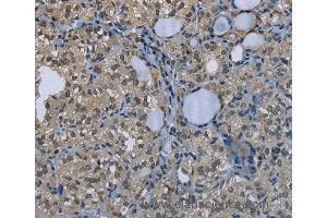 Immunohistochemistry of Human thyroid cancer using GYS1 Polyclonal Antibody at dilution of 1:50 (Glycogen Synthase 1 抗体)