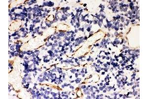 IHC-P: HSP47 antibody testing of human lung cancer tissue (SERPINH1 抗体  (AA 247-418))