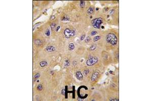 Formalin-fixed and paraffin-embedded human hepatocarcinoma tissue reacted with *ALDH6A1 antibody , which was peroxidase-conjugated to the secondary antibody, followed by DAB staining. (ALDH6A1 抗体  (C-Term))