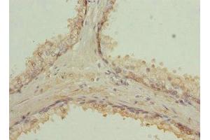 Immunohistochemistry of paraffin-embedded human prostate cancer using ABIN7167389 at dilution of 1:100 (RAB9A 抗体  (AA 122-201))