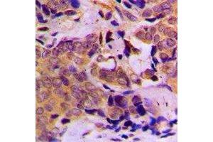 Immunohistochemical analysis of DOK1 staining in human breast cancer formalin fixed paraffin embedded tissue section. (DOK1 抗体)