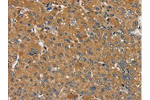 The image on the left is immunohistochemistry of paraffin-embedded Human liver cancer tissue using ABIN7192302(SEMA6D Antibody) at dilution 1/25, on the right is treated with synthetic peptide. (SEMA6D 抗体)