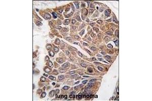 Formalin-fixed and paraffin-embedded human lung carcinoma tissue reacted with AKT2 antibody (C-term), which was peroxidase-conjugated to the secondary antibody, followed by DAB staining. (AKT2 抗体  (C-Term))