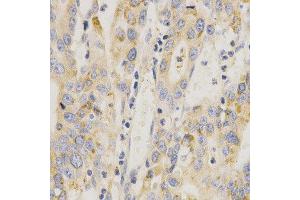 Immunohistochemistry of paraffin-embedded human stomach cancer using MAP2K6 antibody at dilution of 1:200 (x400 lens) (MAP2K6 抗体  (AA 1-334))