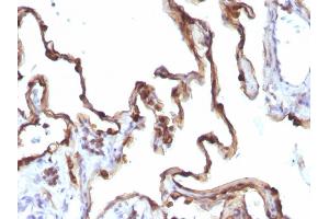 Formalin-fixed, paraffin-embedded human Lung Carcinoma stained with Cytokeratin 7 Mouse Monoclonal Antibody (KRT7/1198). (Cytokeratin 7 抗体)
