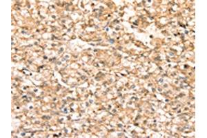 The image on the left is immunohistochemistry of paraffin-embedded Human prostate cancer tissue using ABIN7192443(SLC25A38 Antibody) at dilution 1/20, on the right is treated with synthetic peptide. (SLC25A38 抗体)