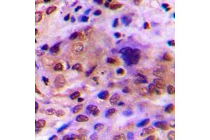 Immunohistochemical analysis of RAD51C staining in human breast cancer formalin fixed paraffin embedded tissue section. (RAD51C 抗体  (Center))