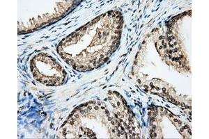 Immunohistochemical staining of paraffin-embedded Adenocarcinoma of ovary tissue N93ing anti-CYP1A2 mouse monoclonal antibody. (CYP1A2 抗体)
