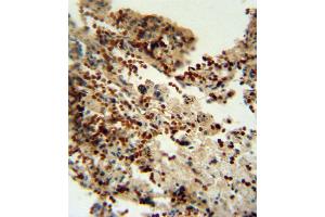 INDO antibody (Center) (ABIN650713 and ABIN2839358) immunohistochemistry analysis in formalin fixed and paraffin embedded human lung carcinoma followed by peroxidase conjugation of the secondary antibody and DAB staining. (IDO1 抗体  (AA 79-105))