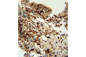 INDO antibody (Center) (ABIN650713 and ABIN2839358) immunohistochemistry analysis in formalin fixed and paraffin embedded human lung carcinoma followed by peroxidase conjugation of the secondary antibody and DAB staining.