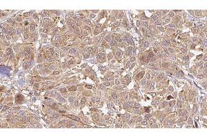 ABIN6276505 at 1/100 staining Human Melanoma tissue by IHC-P. (C19orf10 抗体)