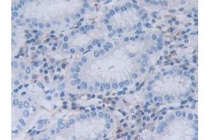 Detection of RNASEL in Human Stomach cancer Tissue using Polyclonal Antibody to Ribonuclease L (RNASEL) (RNASEL 抗体  (AA 358-583))