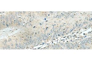 Immunohistochemistry of paraffin-embedded Human colorectal cancer tissue using DENND6A Polyclonal Antibody at dilution of 1:120(x200) (FAM116A 抗体)
