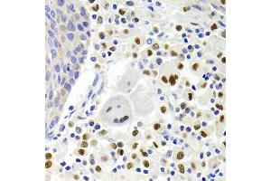 Immunohistochemistry of paraffin-embedded human lung cancer using GEMIN2 Antibody (ABIN1872798) at dilution of 1:200 (40x lens). (SIP1 抗体)