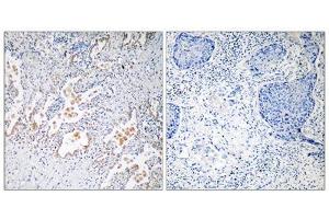 Immunohistochemistry analysis of paraffin-embedded human lung carcinoma tissue using GNB5 antibody. (GNB5 抗体  (Internal Region))