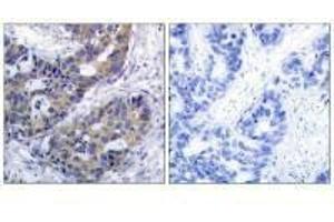 Immunohistochemistry analysis of paraffin-embedded human breast carcinoma tissue, using IRS-1 (Ab-312) antibody.