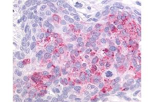 Anti-GPR55 antibody IHC of human Ovary, Carcinoma. (GPR55 抗体  (C-Term))
