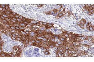 ABIN6277405 at 1/100 staining Human Head and neck cancer tissue by IHC-P.