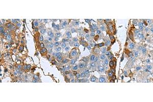 Immunohistochemistry of paraffin-embedded Human liver cancer tissue using TGFBI Polyclonal Antibody at dilution of 1:60(x200) (TGFBI 抗体)