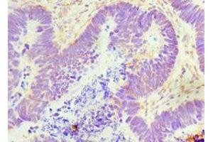 Immunohistochemistry of paraffin-embedded human ovarian cancer using ABIN7154549 at dilution of 1:100 (GDF5 抗体  (AA 202-501))