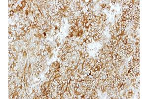 IHC-P Image Immunohistochemical analysis of paraffin-embedded DLD1 xenograft, using GMDS, antibody at 1:500 dilution. (GMDS 抗体)