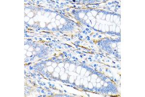 Immunohistochemistry of paraffin-embedded human liver cancer using LPP Rabbit mAb (ABIN7268284) at dilution of 1:100 (40x lens). (LPP 抗体)